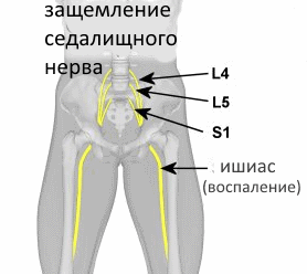 Тренировки с межпозвоночной грыжей. - Бодибилдинг форум AnabolicShops